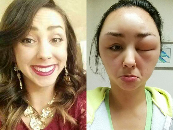 Girl has an insane allergic reaction to hair-dye