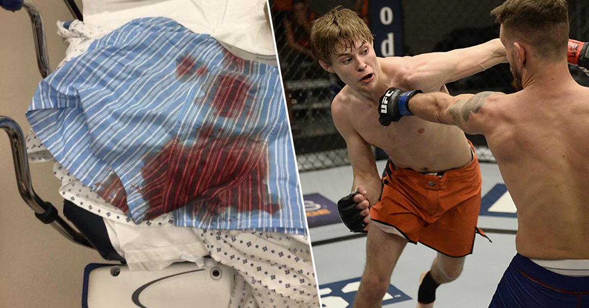 Worst Ufc Injuries – 5 of the worst injuries in UFC history – CEMG